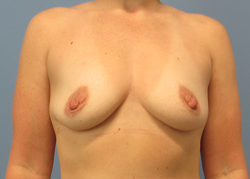 Breast Augmentation The Woodlands