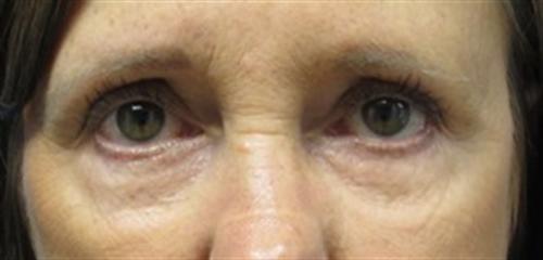 Eyelid Surgery in The Woodlands
