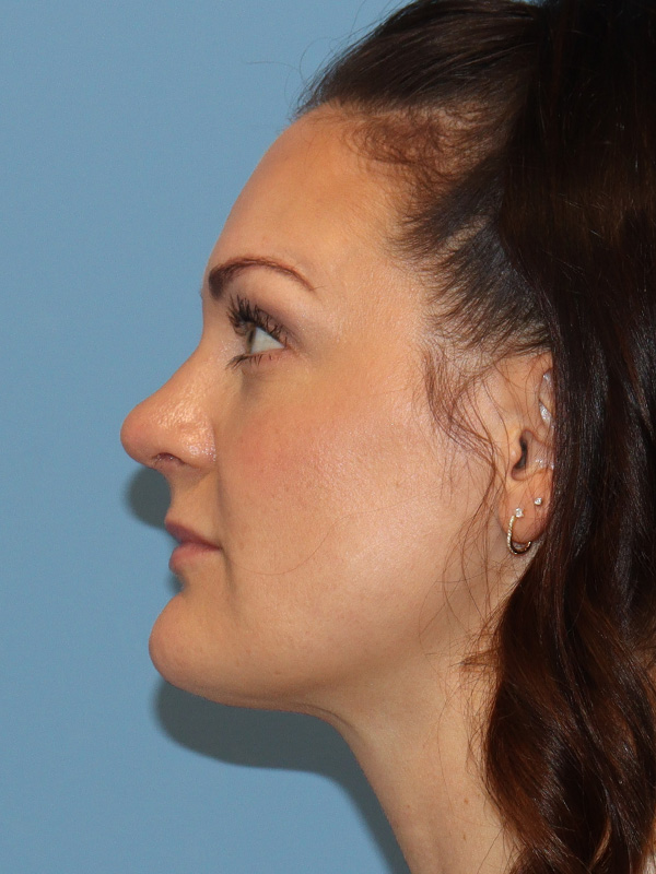 Rhinoplasty Before and After | SGK Plastic Surgery