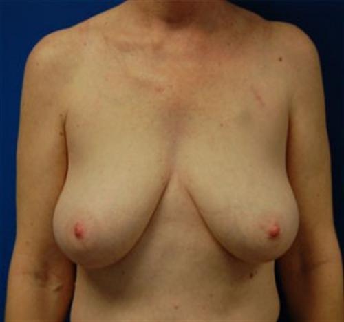 Breast Reconstruction Before and After | SGK Plastic Surgery