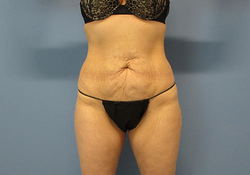 Liposuction Before and After | SGK Plastic Surgery