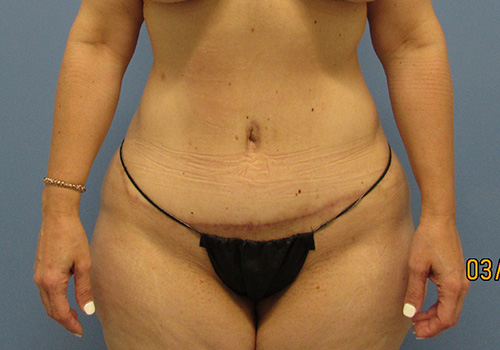 Tummy Tuck Before and After | SGK Plastic Surgery