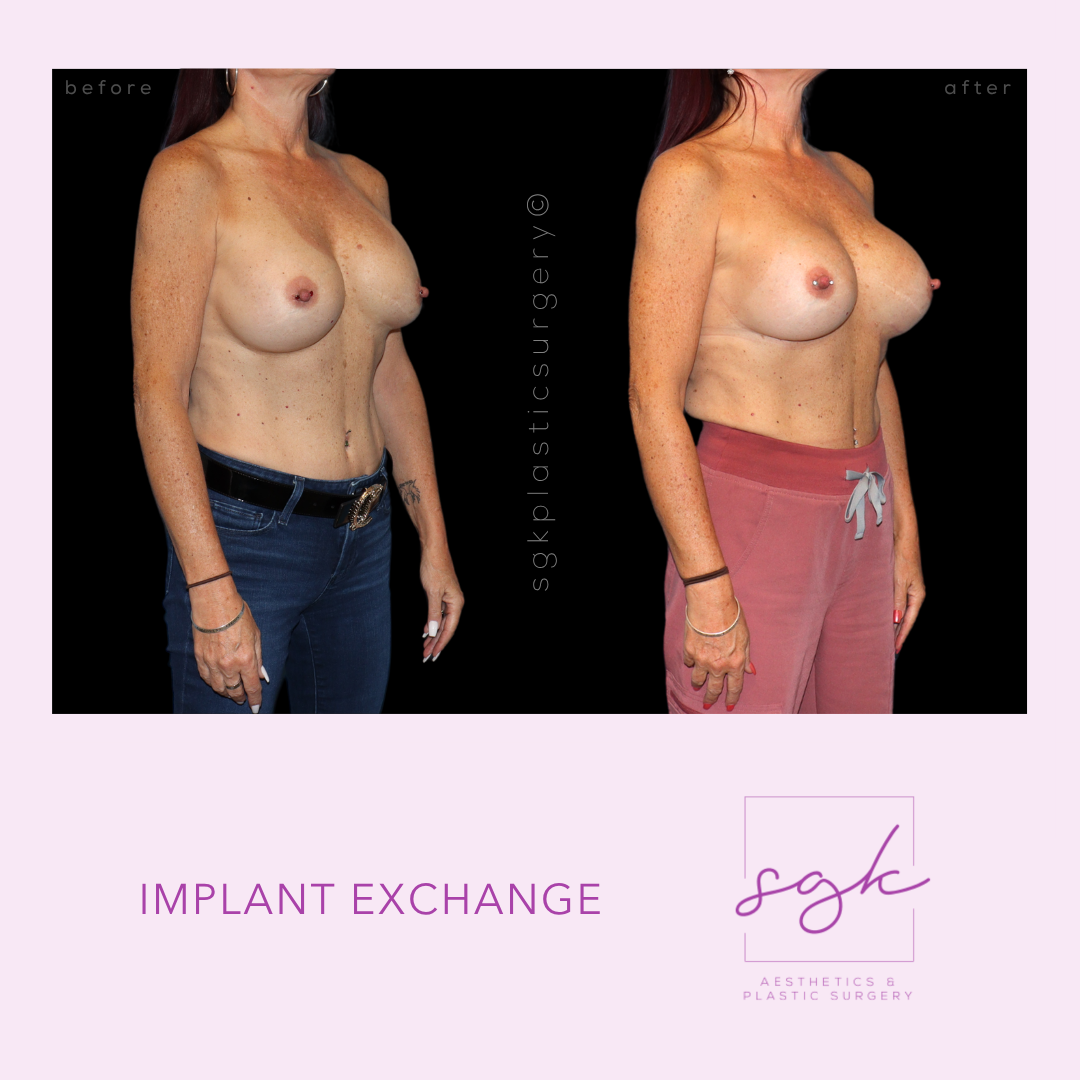 Implant Exchange Before and After