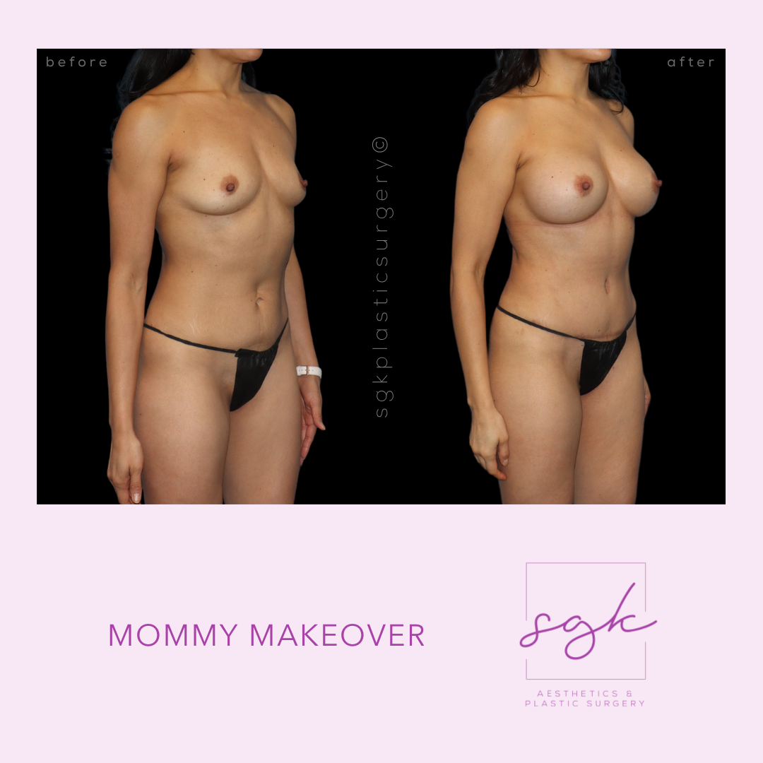 Mommy Makeover Before and After