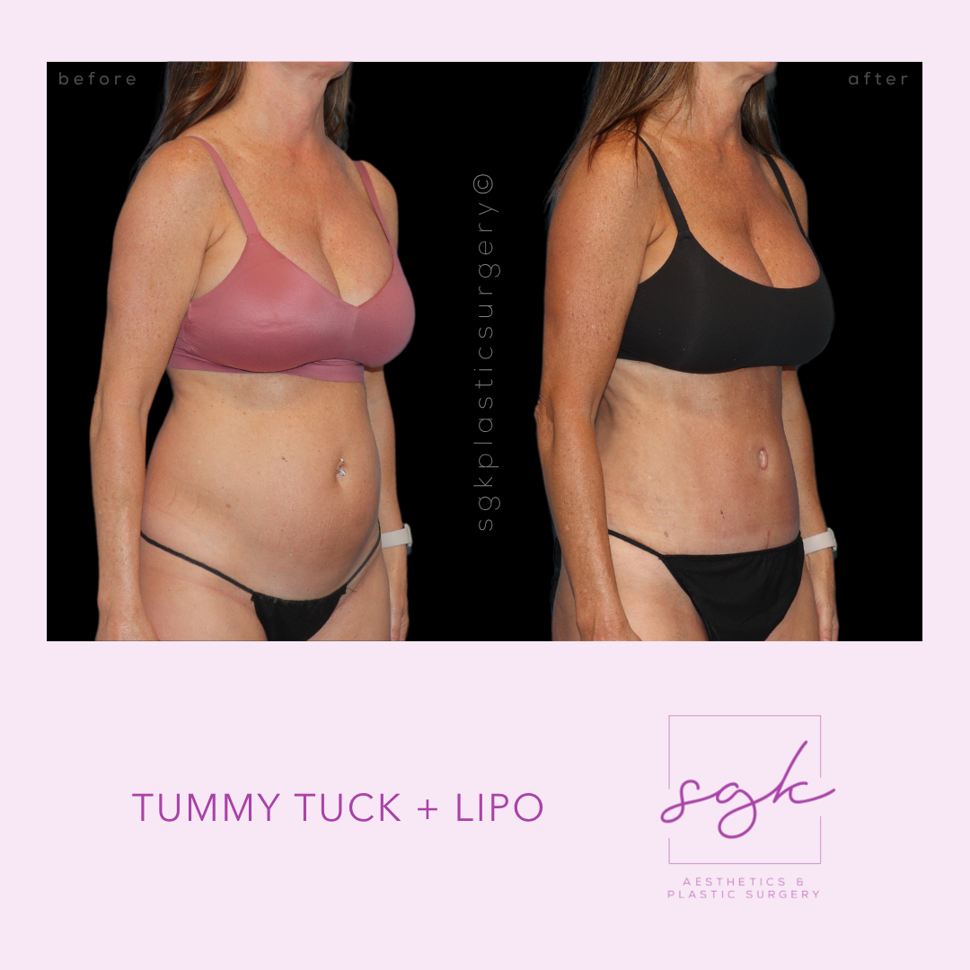 Tummy Tuck + Lipo Before and After