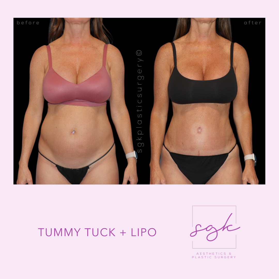Tummy Tuck + Lipo Before and After