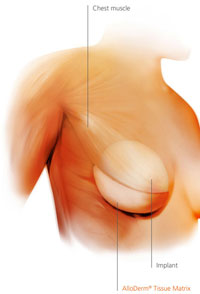 Alloderm breast reconstruction study