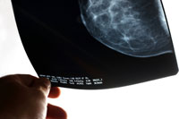 mammograms after fat transfer breast augmentation