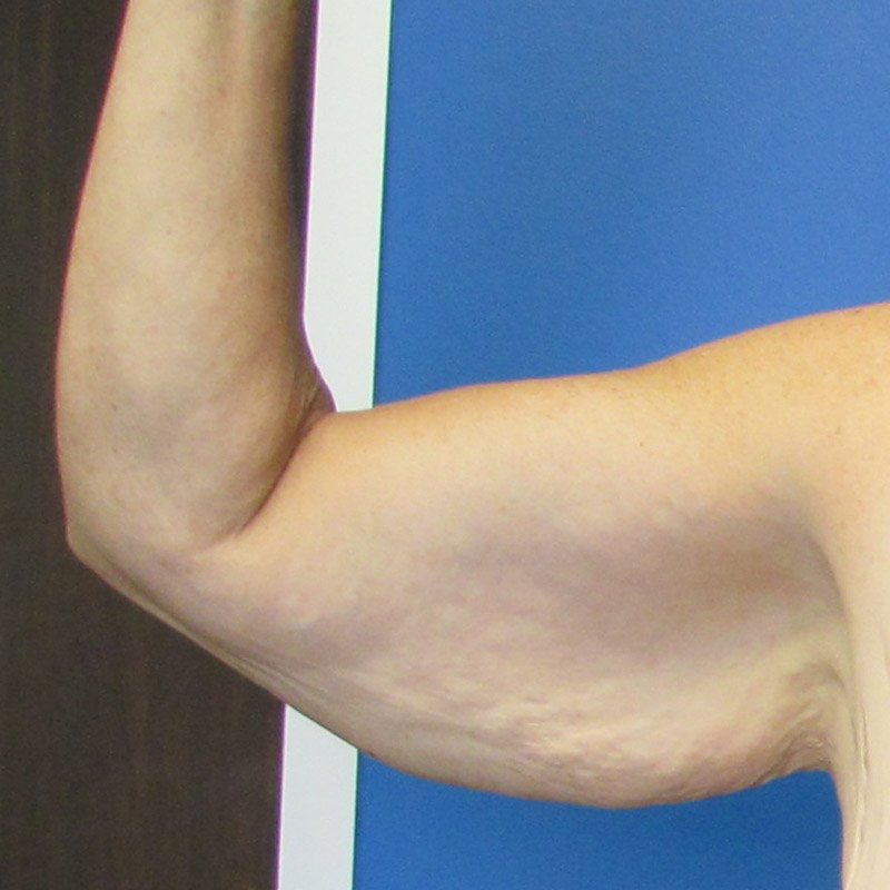 Arm Lift Before and After | SGK Plastic Surgery
