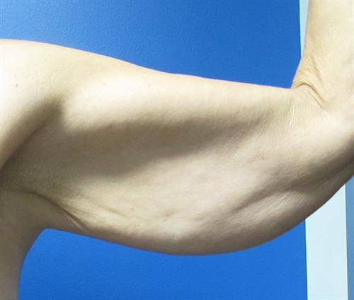 Arm Lift Before and After | SGK Plastic Surgery