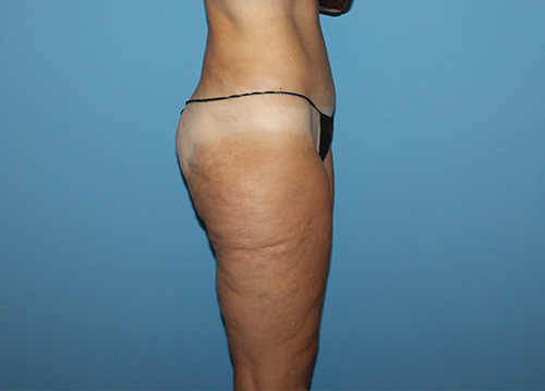 Liposuction Before and After | SGK Plastic Surgery