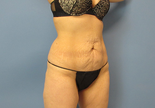 Liposuction Before and After | SGK Plastic Surgery