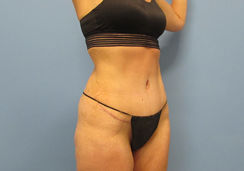 Liposuction Before and After | SGK Plastic Surgery