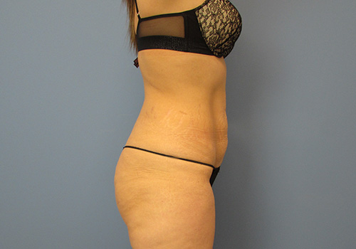 Liposuction Before and After | SGK Plastic Surgery