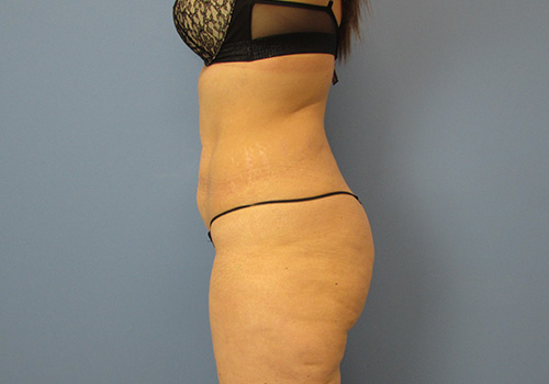 Liposuction Before and After | SGK Plastic Surgery