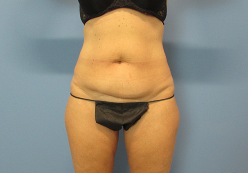 Liposuction Before and After | SGK Plastic Surgery