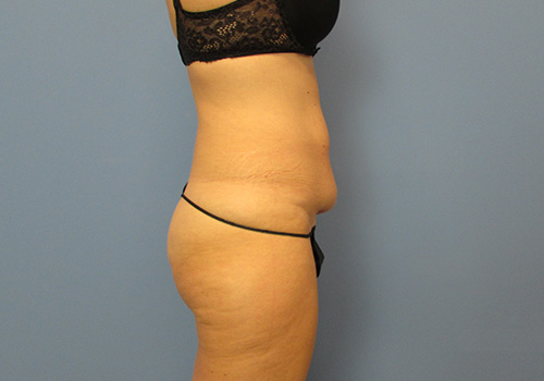 Liposuction Before and After | SGK Plastic Surgery