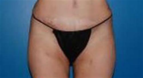 Liposuction in The Woodlands, TX