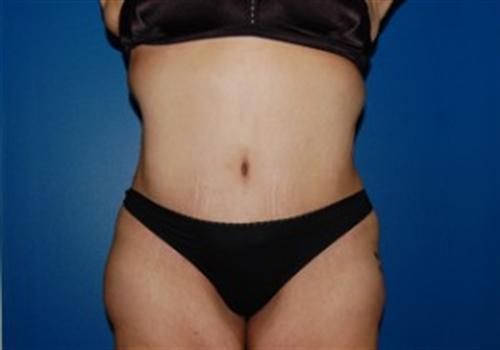 Liposuction Before and After | SGK Plastic Surgery