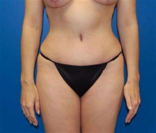 Liposuction Before and After | SGK Plastic Surgery