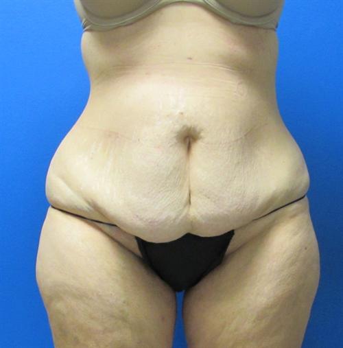 Liposuction Before and After | SGK Plastic Surgery