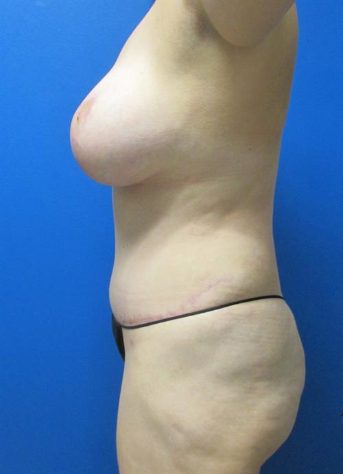 Liposuction Before and After | SGK Plastic Surgery