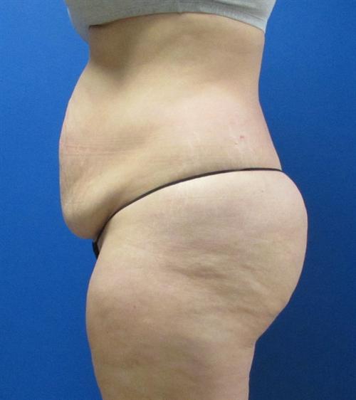 Liposuction Before and After | SGK Plastic Surgery