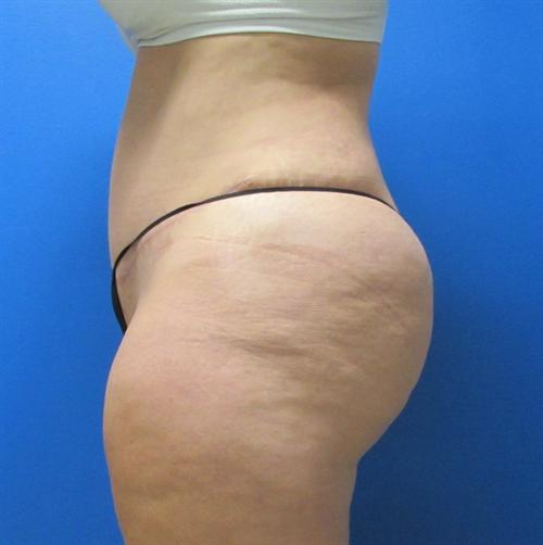 Liposuction Before and After | SGK Plastic Surgery