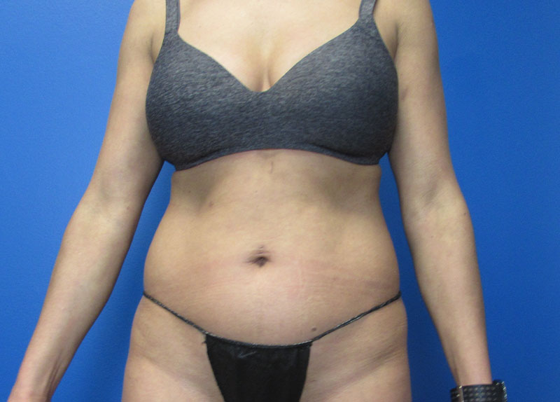 Liposuction Before and After | SGK Plastic Surgery