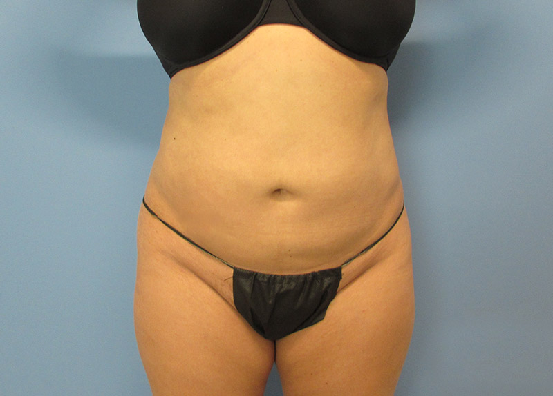 Liposuction Before and After | SGK Plastic Surgery