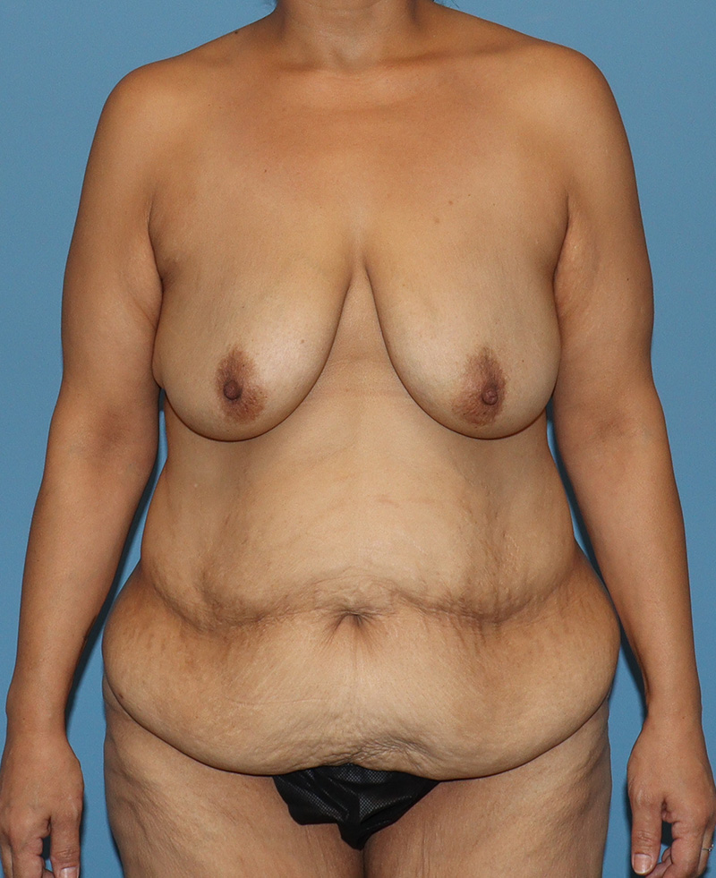 Tummy Tuck The Woodlands