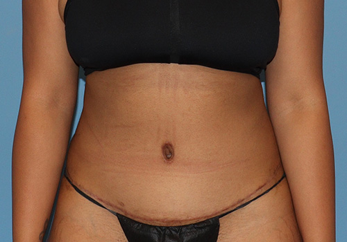 Tummy Tuck Before and After | SGK Plastic Surgery