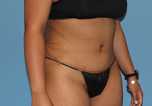 Tummy Tuck Before and After | SGK Plastic Surgery