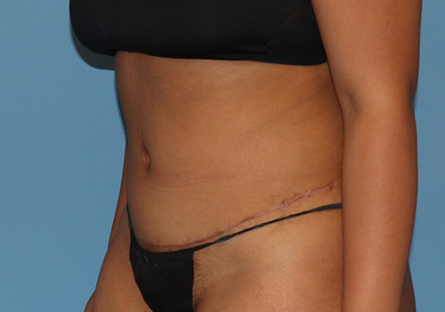 Tummy Tuck Before and After | SGK Plastic Surgery