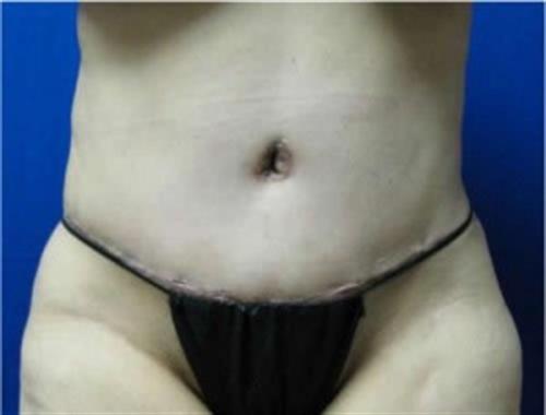 Tummy Tuck Before and After | SGK Plastic Surgery