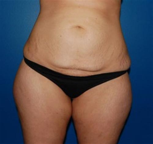 Tummy Tuck Before and After | SGK Plastic Surgery