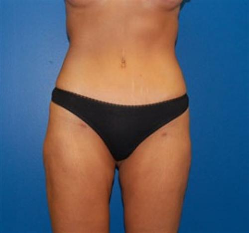 Tummy Tuck Before and After | SGK Plastic Surgery