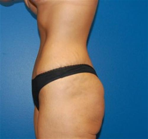 Tummy Tuck Before and After | SGK Plastic Surgery