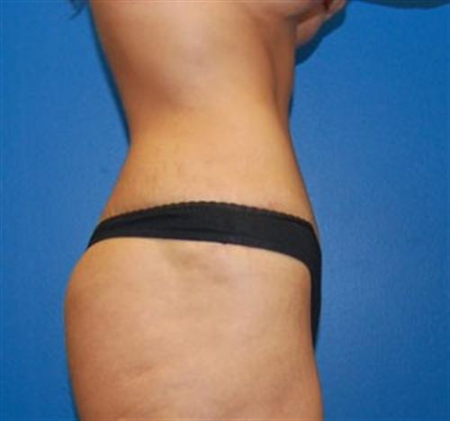 Tummy Tuck Before and After | SGK Plastic Surgery