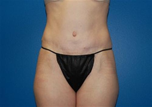 Tummy Tuck Before and After | SGK Plastic Surgery