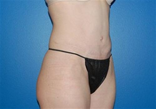 Tummy Tuck Before and After | SGK Plastic Surgery