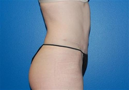 Tummy Tuck Before and After | SGK Plastic Surgery