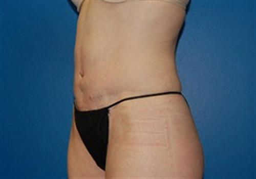 Tummy Tuck Before and After | SGK Plastic Surgery