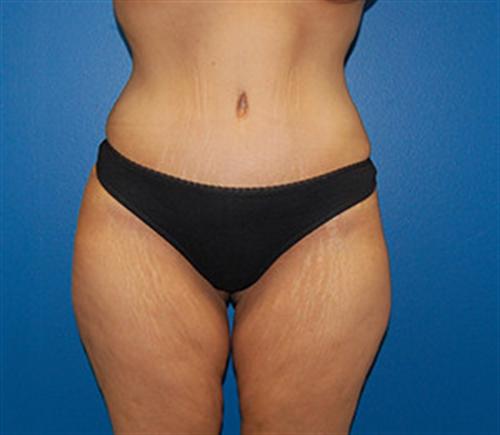 Tummy Tuck Before and After | SGK Plastic Surgery