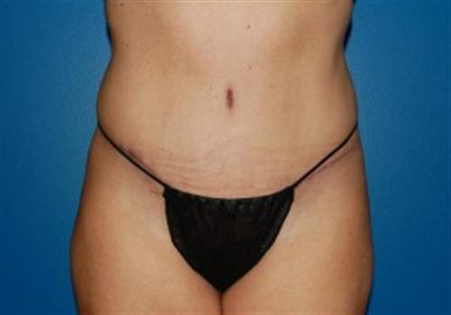 Tummy Tuck Before and After | SGK Plastic Surgery