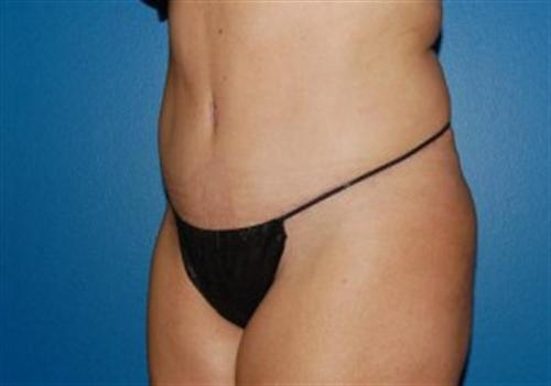 Tummy Tuck Before and After | SGK Plastic Surgery