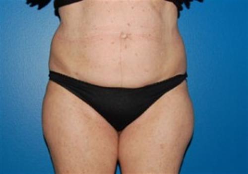 Tummy Tuck Before and After | SGK Plastic Surgery