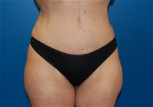 Tummy Tuck Before and After | SGK Plastic Surgery