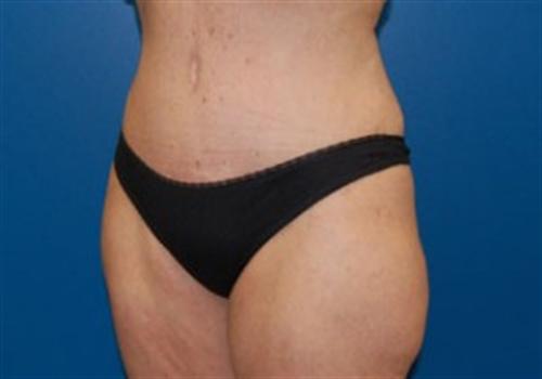 Tummy Tuck Before and After | SGK Plastic Surgery