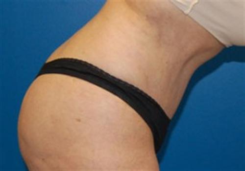 Tummy Tuck Before and After | SGK Plastic Surgery